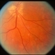 color equatorial fundus photo showing multifocal choroiditis